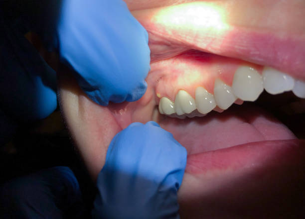 Best Emergency Treatment for Dental Infections or Abscesses in Eagle, NE